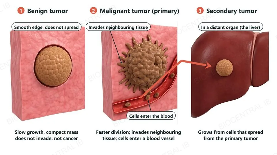 Three numbered cut-away views: a benign tumor, a compact rounded mass with a smooth edge that does not invade; a malignant primary tumor with an irregular edge invading the neighbouring tissue, with cells entering a blood vessel; and a small secondary tumor in a distant organ, the liver, with an arrow from the primary tumor along the blood vessel to it.