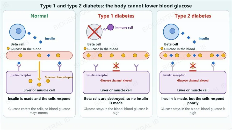 Three columns compared. Normal: a beta cell releases insulin, which binds receptors on a liver or muscle cell, the glucose channel opens and glucose enters the cell, so blood glucose stays normal. Type 1 diabetes: an immune cell attacks the beta cell, which is crossed out, so no insulin is made, the receptors are empty, the glucose channel is closed and glucose stays in the blood. Type 2 diabetes: the beta cell makes insulin and it binds to faded receptors, but the glucose channel stays closed because the cells respond poorly, so glucose stays in the blood.
