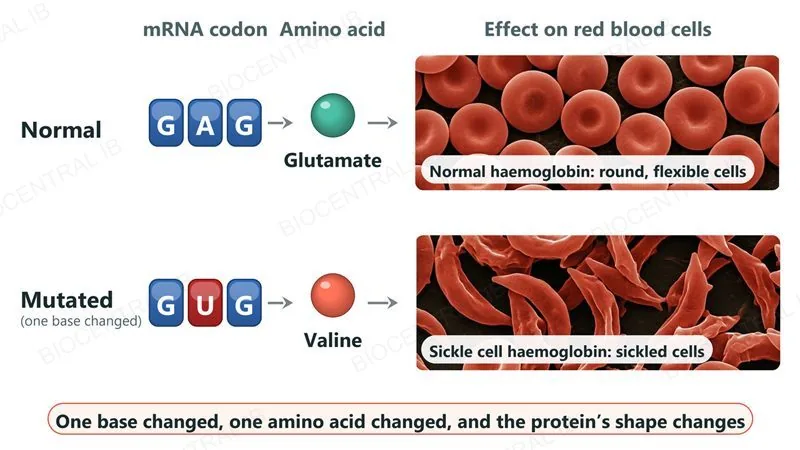 Two rows. Normal: the codon GAG gives glutamate, and normal haemoglobin gives round, flexible red blood cells (electron micrograph style image). Mutated: the middle base changes so the codon is GUG, giving valine, and sickle cell haemoglobin gives crescent-shaped sickled red blood cells.